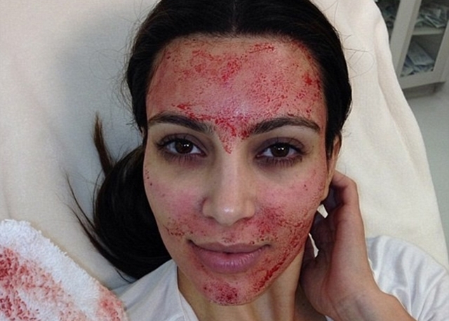 lifting de vampiro: kim kardashian